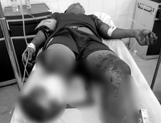 Hỗn chiến giữa đêm, thiếu niên 15 tuổi bị chém đứt lìa chân