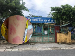 Bé 21 tháng tuổi ở Thái Bình bị bạn cắn tím người: Hiệu trưởng lên tiếng