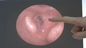 Kinh dị: 40 con giòi lúc nhúc trong tai người đàn ông Quảng Nam