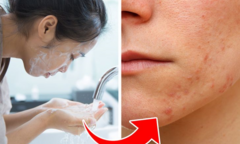 7 sai lầm hầu như ai cũng mắc khiến da dễ nổi mụn