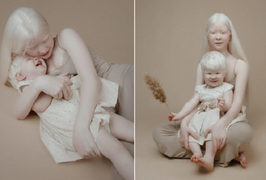 Vẻ đẹp thiên thần của 2 chị em bạch tạng 'đốn tim' cộng đồng mạng