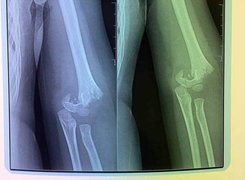 Bé 5 tuổi ở Hà Nội ngã gãy tay: Nhà trường lên tiếng