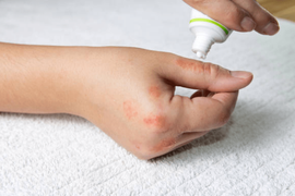 Bị kiến ba khoang tấn công, cả trăm người Hà Nội nhập viện mỗi ngày