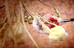 Khám, tầm soát ung thư vú miễn phí tại Bệnh viện Chợ Rẫy