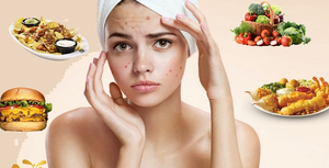 Mặt nhiều mụn, hãy tránh xa 7 loại thực phẩm này