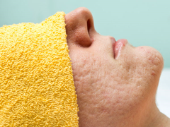 5 nguyên nhân khiến bạn bị lỗ chân lông to