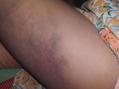  Học sinh lớp 3 ở Đắk Lắk bị cô giáo đánh bầm tím đùi