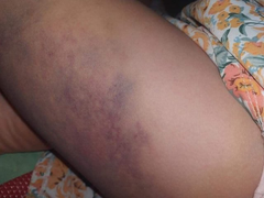 Vì sao học sinh lớp 3 ở Đắk Lắk bị cô giáo đánh bầm tím đùi