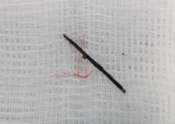 Phẫu thuật lấy kim khâu gỉ đen trong cơ thể bé 3 tuổi