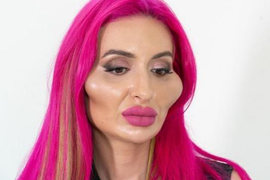 Cặp gò má lồi lõm thảm họa của người mẫu nghiện tiêm filler