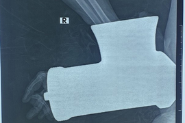 Bị máy xay thịt 'nuốt' trọn bàn tay, người phụ nữ vác cả máy đến viện cầu cứu