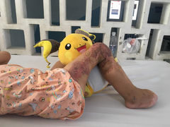 Xót xa nhìn đôi bàn chân bé gái mất 9 ngón sau 18 lần phẫu thuật