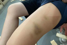 Xác minh việc phụ huynh tố cô giáo dùng thước đánh bầm tím chân tay trẻ lớp 1