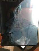 Thua đá bóng, nam sinh về gọi anh đánh bạn chấn thương mũi