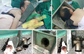 Nam thanh niên mang cối xay thịt 'nuốt' cánh tay đi cấp cứu