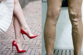 Đi giày cao gót, mặc váy bó: Cẩn thận giãn tĩnh mạch