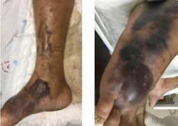 Dấu hiệu nhận biết và cách phòng ngừa vi khuẩn ăn thịt người Whitmore 