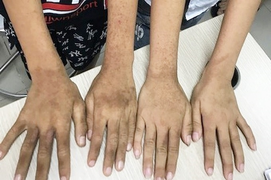 Hai bé 10 tuổi ở Hà Nội mắc bệnh cực hiếm, nổi mụn khắp người khi ra nắng