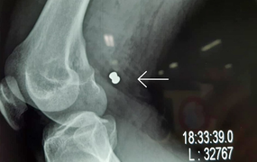 Cứu người đàn ông bị đạn găm vào đùi