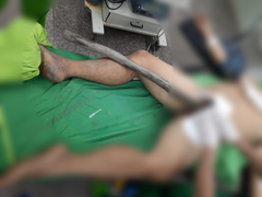 Cây gỗ dài 1,5m xuyên thẳng từ tầng sinh môn vào thành bụng người đàn ông