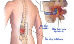 Thoát vị đĩa đệm thắt lưng: Triệu chứng, cách điều trị