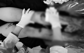 Tự chế pháo nổ, nam thanh niên bị dập nát bàn tay