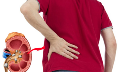5 dấu hiệu cảnh báo bệnh sỏi thận