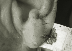 Cứa tai, chích máu tay chữa đột quỵ: Phương pháp chữa bệnh mù quáng