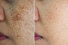 10 mẹo giúp giảm nám da, sạm da lành tính, hiệu quả