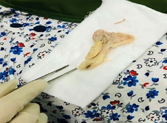 Cứu kịp thời người phụ nữ bị sặc thịt vịt