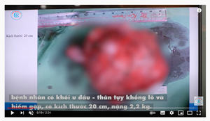 Bóc tách thành công khối u nặng tới 2,2kg cho người phụ nữ ở TP.HCM