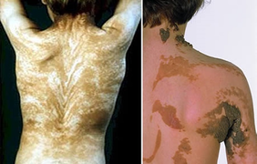 Những căn bệnh kỳ lạ nhất thế giới