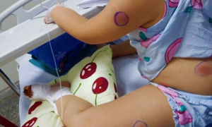 Bé gái 6 tuổi ở Quảng Bình nhiễm vi khuẩn 'ăn thịt người'