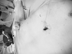 Cứu sống người đàn ông bị dao đâm thấu ngực