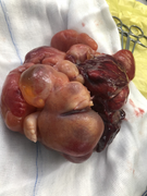 Phẫu thuật thành công cho bé gái 1 ngày tuổi nghi thai trong thai cực hiếm gặp