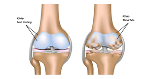 GUMI S - Bước đột phá mới trong hỗ trợ điều trị thoái hóa khớp