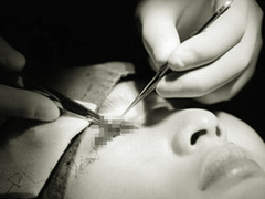 Cắt mí làm đẹp tại spa, cô gái trẻ mù một mắt, tính mạng bị đe doạ