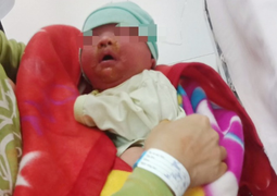 Tắm bằng nước lá cây, bé 20 ngày tuổi bị nhiễm độc nặng