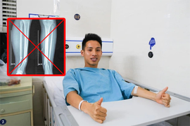 Phim chụp X-quang gãy đôi chân cộng đồng mạng chia sẻ không phải của Hùng Dũng