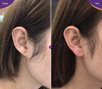 Tiêm filler vào vành tai, tài lộc chưa thấy đã phải nhập viện