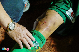 Đầu gối cầu thủ đội Sài Gòn biến dạng sau cú đạp từ đối thủ