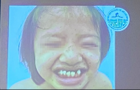 Bé gái mắc hội chứng 'con báo' đầu tiên ở Việt Nam