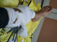 Va chạm với xe ba gác, nam thanh niên bị 11 thanh sắt đâm xuyên chân