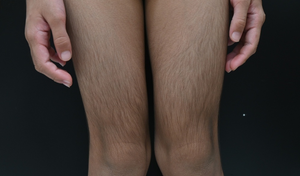 3 người Việt Nam đầu tiên mắc bệnh Cantú hiếm gặp, thế giới ghi nhận 70 ca