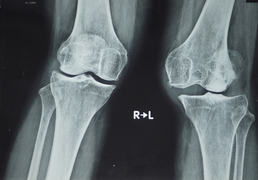 Lần đầu tại Việt Nam phẫu thuật thay khớp gối dạng bản lề bằng titanium