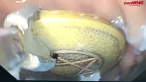 Video: Nội soi gắp đồng xu trong đường tiêu hóa bé gái 8 tuổi ở An Giang