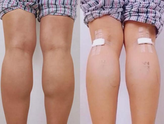 Kiểu làm đẹp rùng rợn của gái trẻ Trung Quốc: Cắt dây thần kinh để bắp chân thon