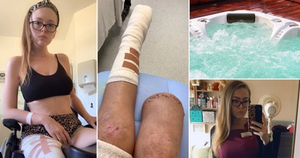 Tiệc tùng say sưa, cô gái tỉnh dậy thấy đã mất một chân 