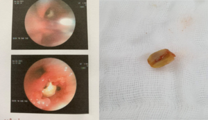 Cụ ông 95 tuổi sốt, khó thở suốt 2 tháng sau khi ăn xôi đậu phộng