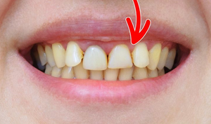 6 thói quen khiến răng bạn ố vàng